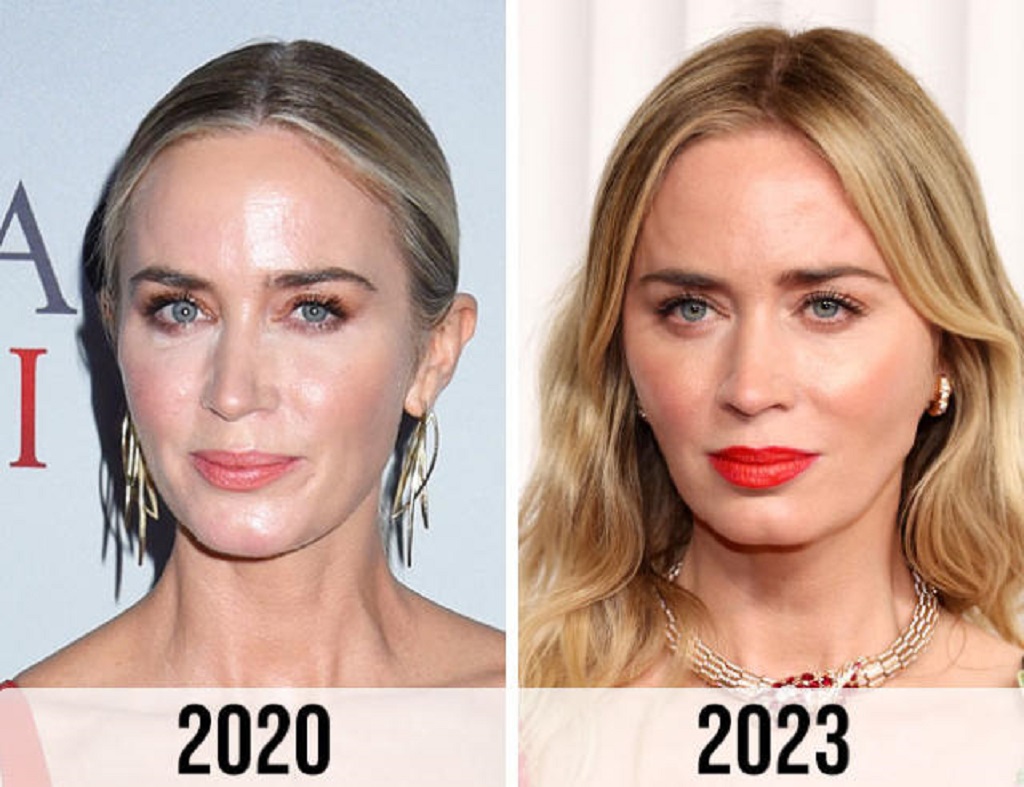 Emily Blunt Botox