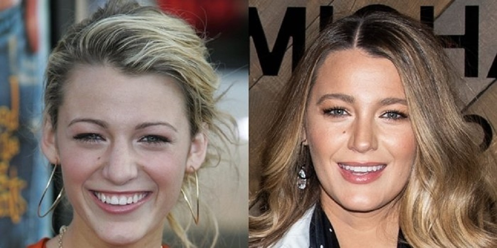 Blake Lively Nose Job