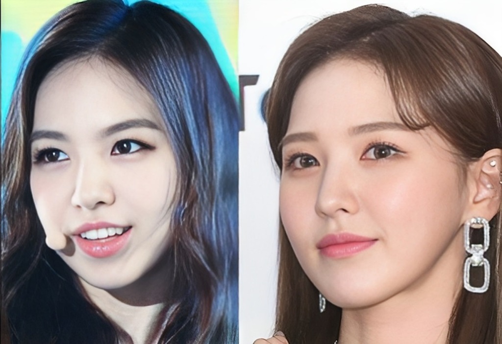 Red Velvet Wendy Plastic Surgery