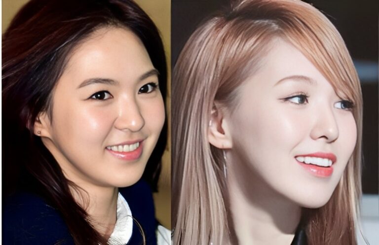 Red Velvet Wendy Plastic Surgery Nose Job Before And After