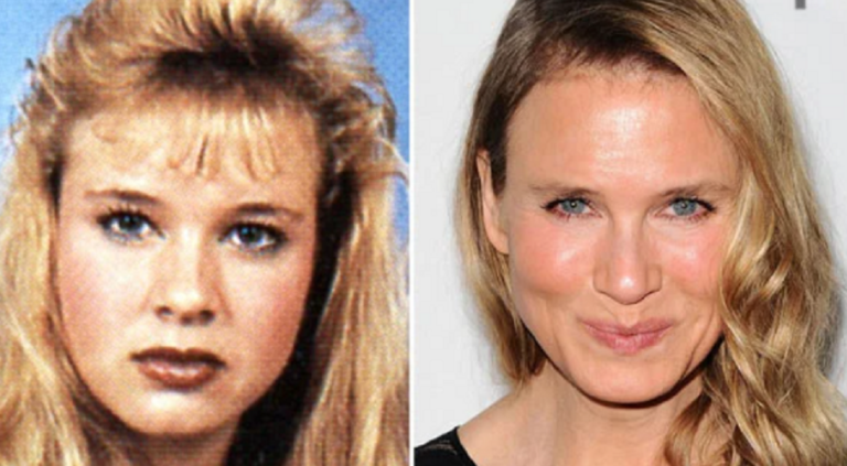 Renee Zellweger Nose Job and Plastic Surgery