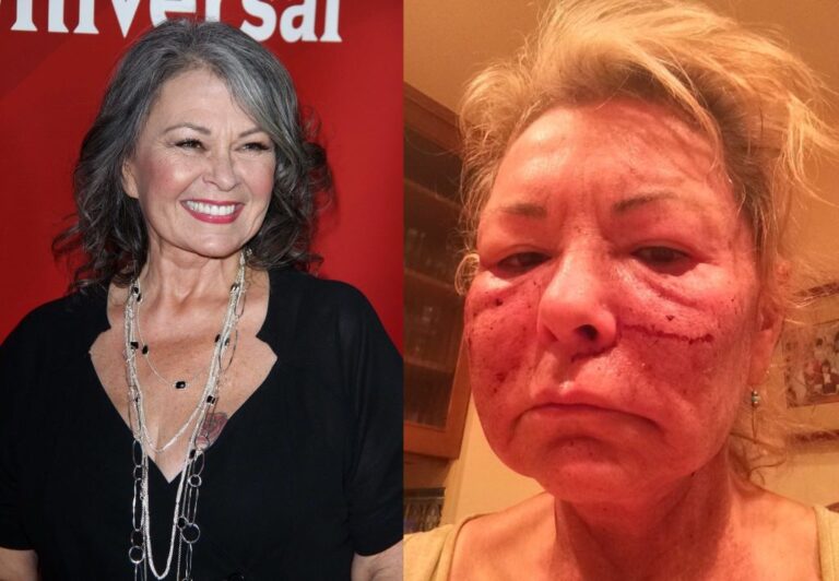 Roseanne Barr Before and After Plastic Surgery Pics – Career and Net Worth