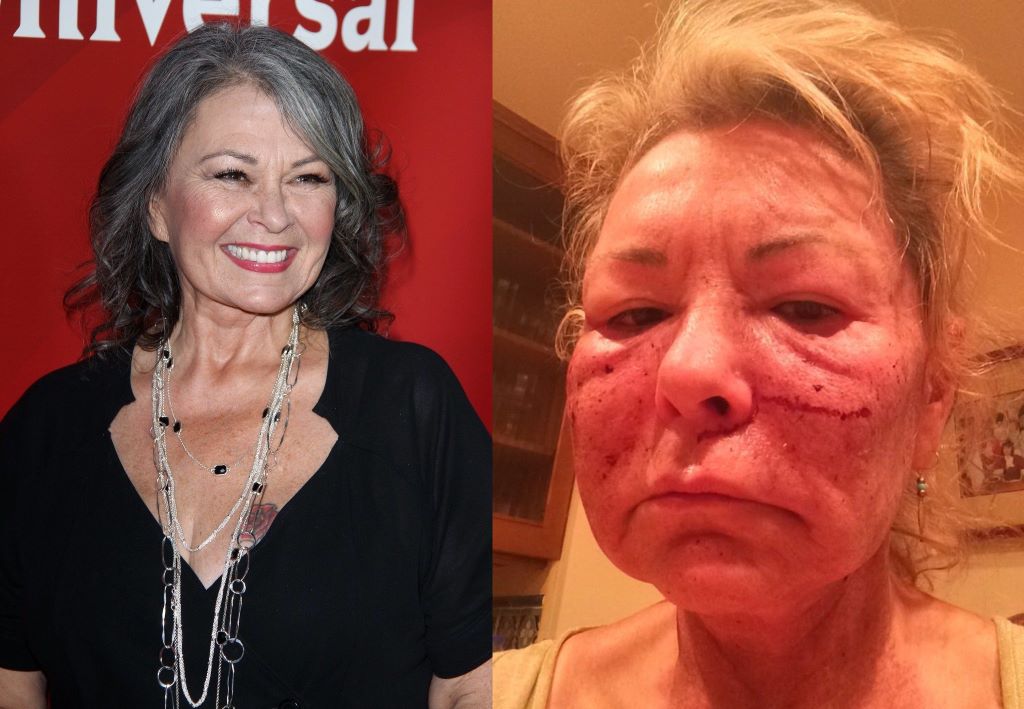 Roseanne Barr Before and After