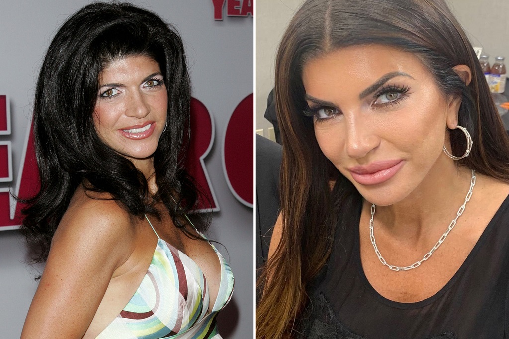 Teresa Giudice Nose Job